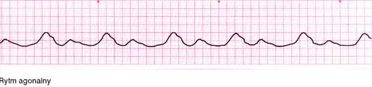 EKG - rytm agonalny.jpg